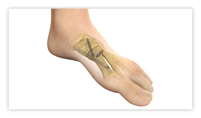 Bunion Surgery